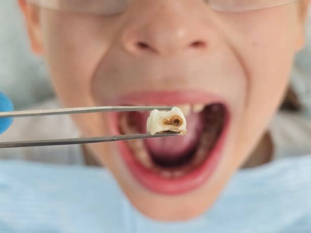Best Emergency Dental Care for Abscessed Tooth in Setauket, NY