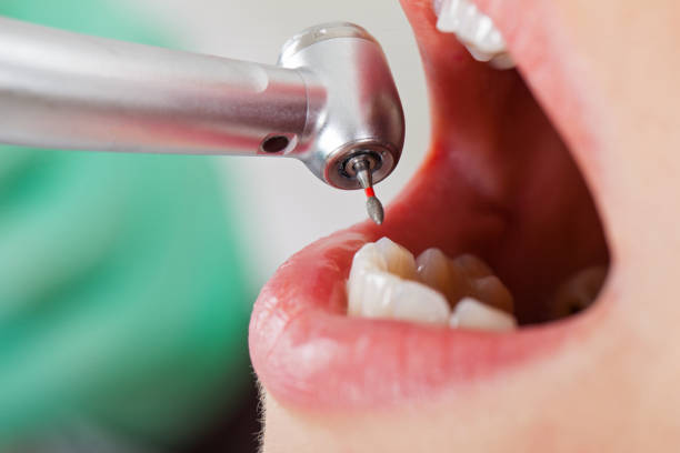 Best Emergency Dentist for Knocked-Out Tooth in Setauket, NY